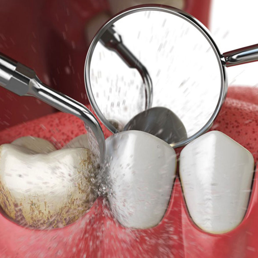 Always Smiles Ultrasonic cleaning is part of promoting good dental health