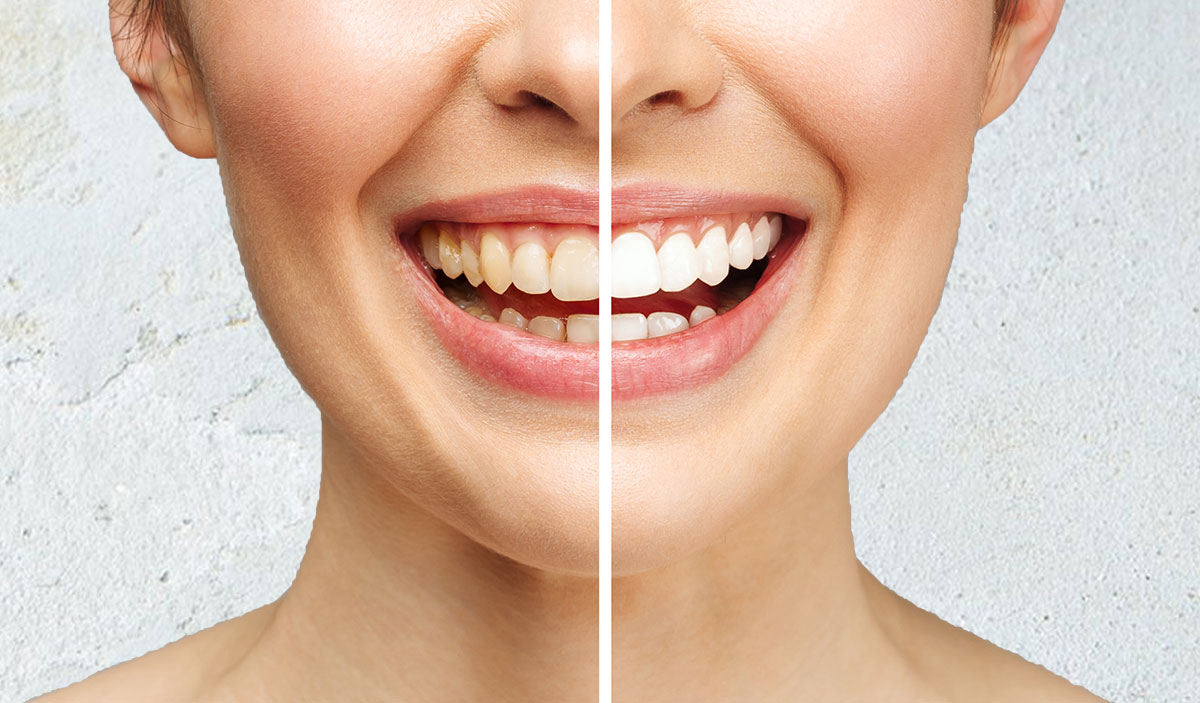 Cosmetic dentistry before and after sydney