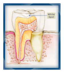 tooth white spot