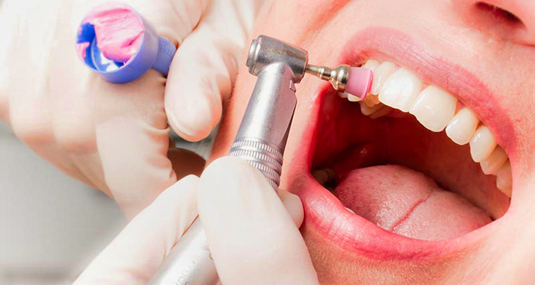 dental prophylaxis always smiles dental clinic