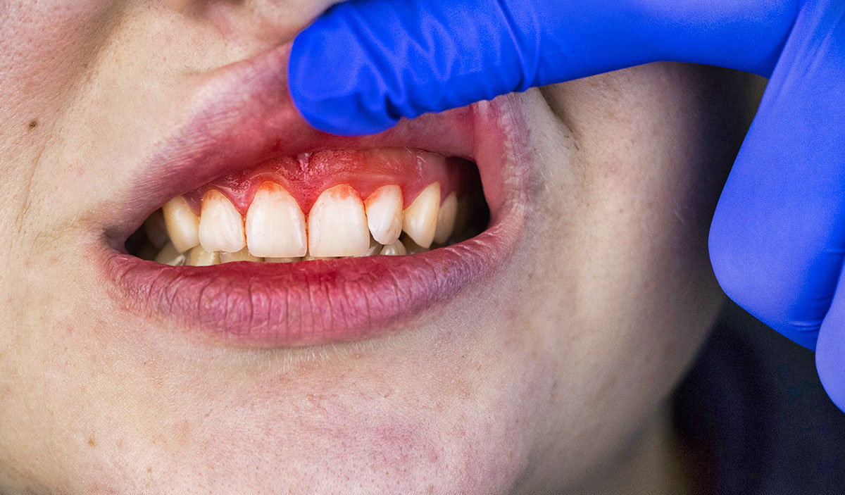 swollen or bleeding gums are signs of gum infection