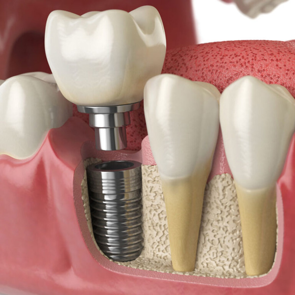 dental implants and other surgical procedures including sleep dentistry