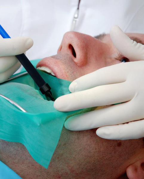 root canal cleaning canley heights