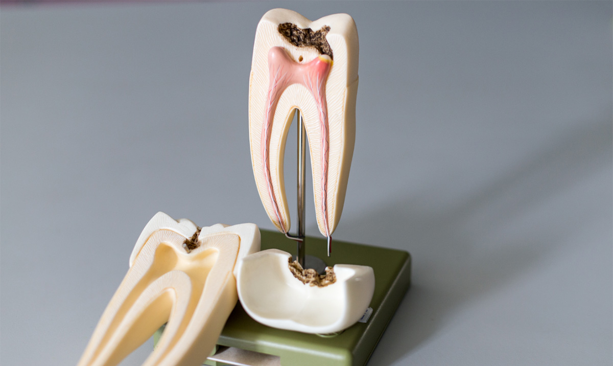 root canal model decayed