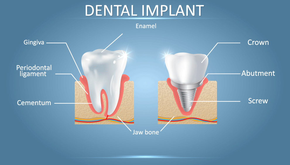 what is an implant visual representation